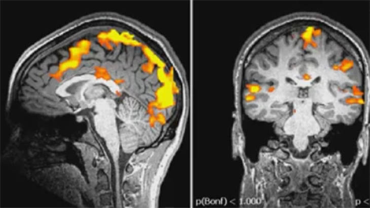 fMRI scan
